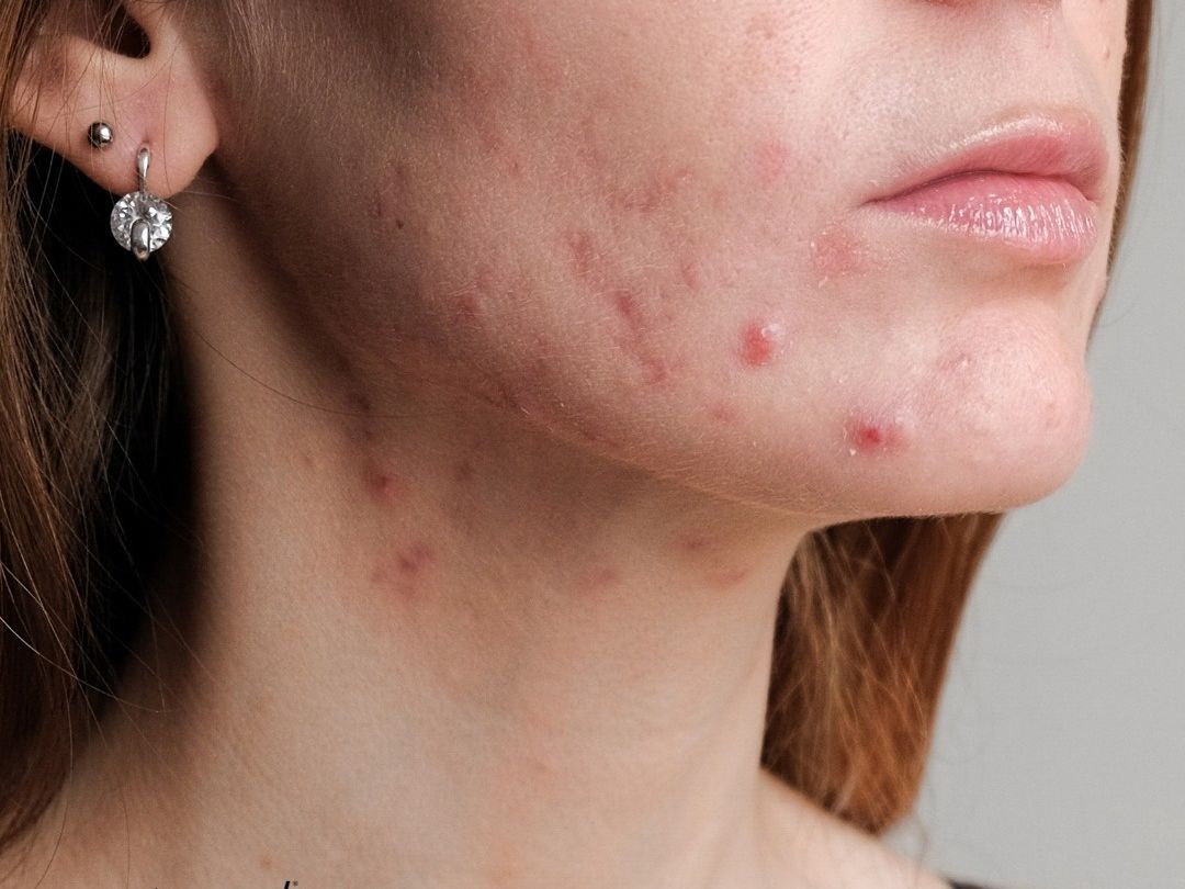 Period breakouts: Το δέρμα σου ξέρει ότι έρχεται περίοδος πριν από εσένα