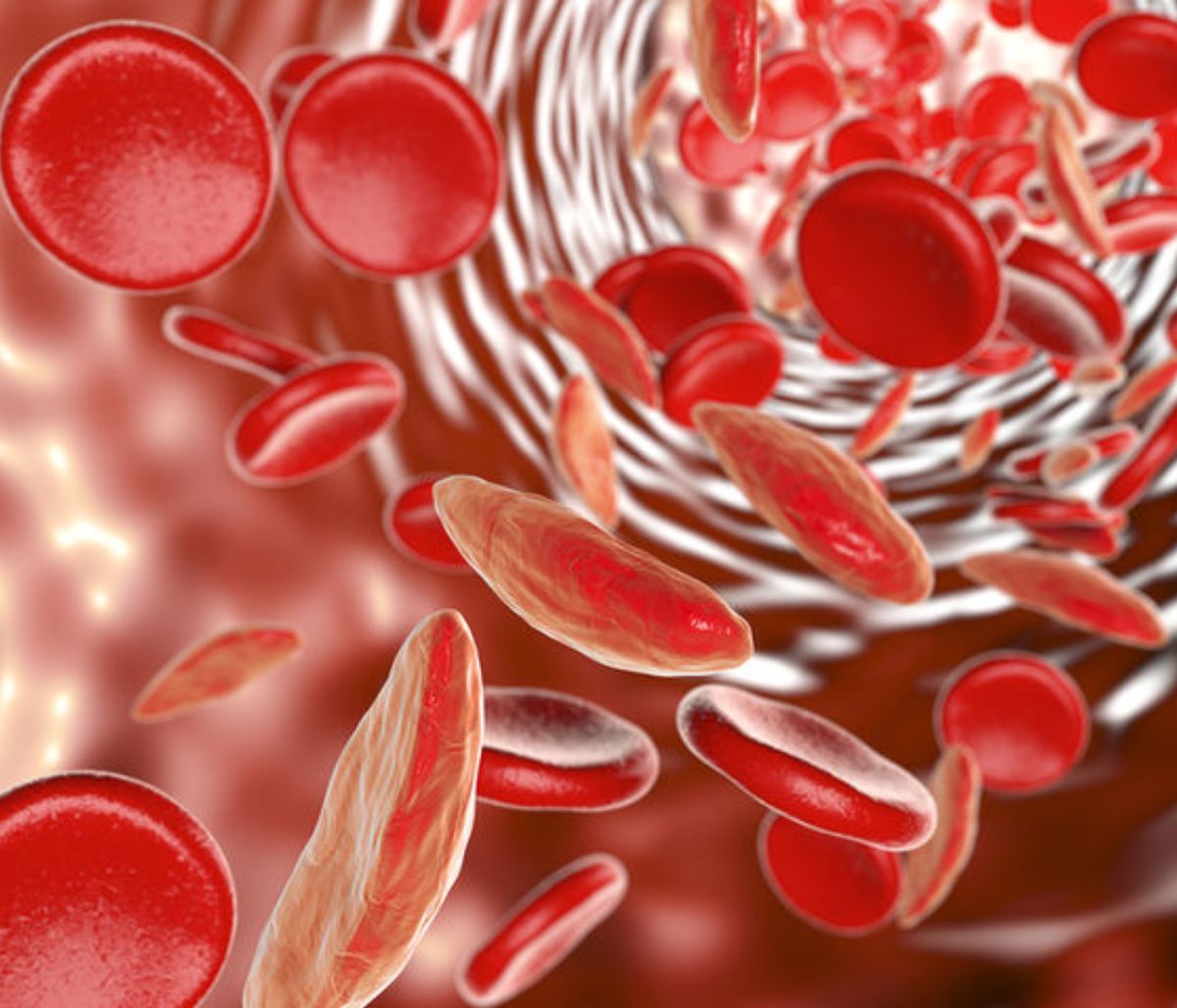 Αναιμία: 6 φρούτα που ενισχύουν την παραγωγή αιμοσφαιρίνης (φωτο)