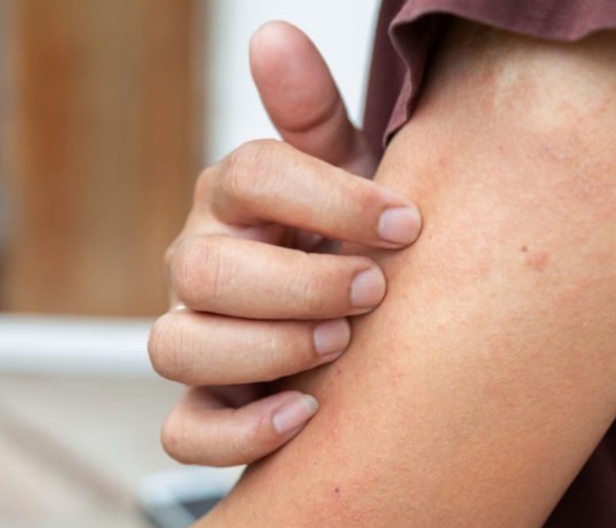 Έκζεμα: Το μπαχαρικό που βοηθά στην αντιμετώπιση της φαγούρας