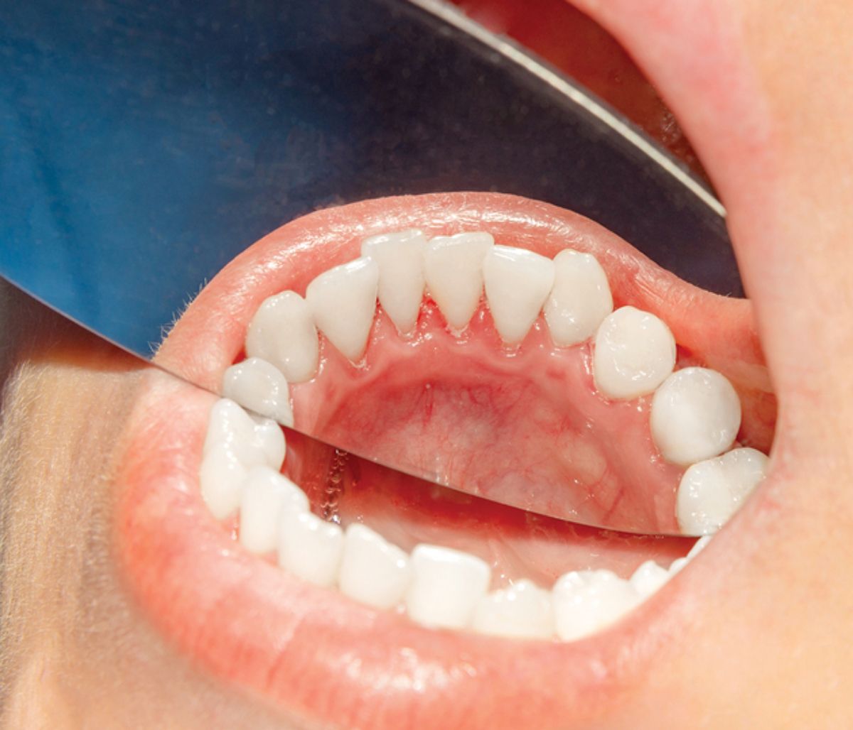 8 συμπτώματα του στόματος που δεν πρέπει να αγνοήσεις