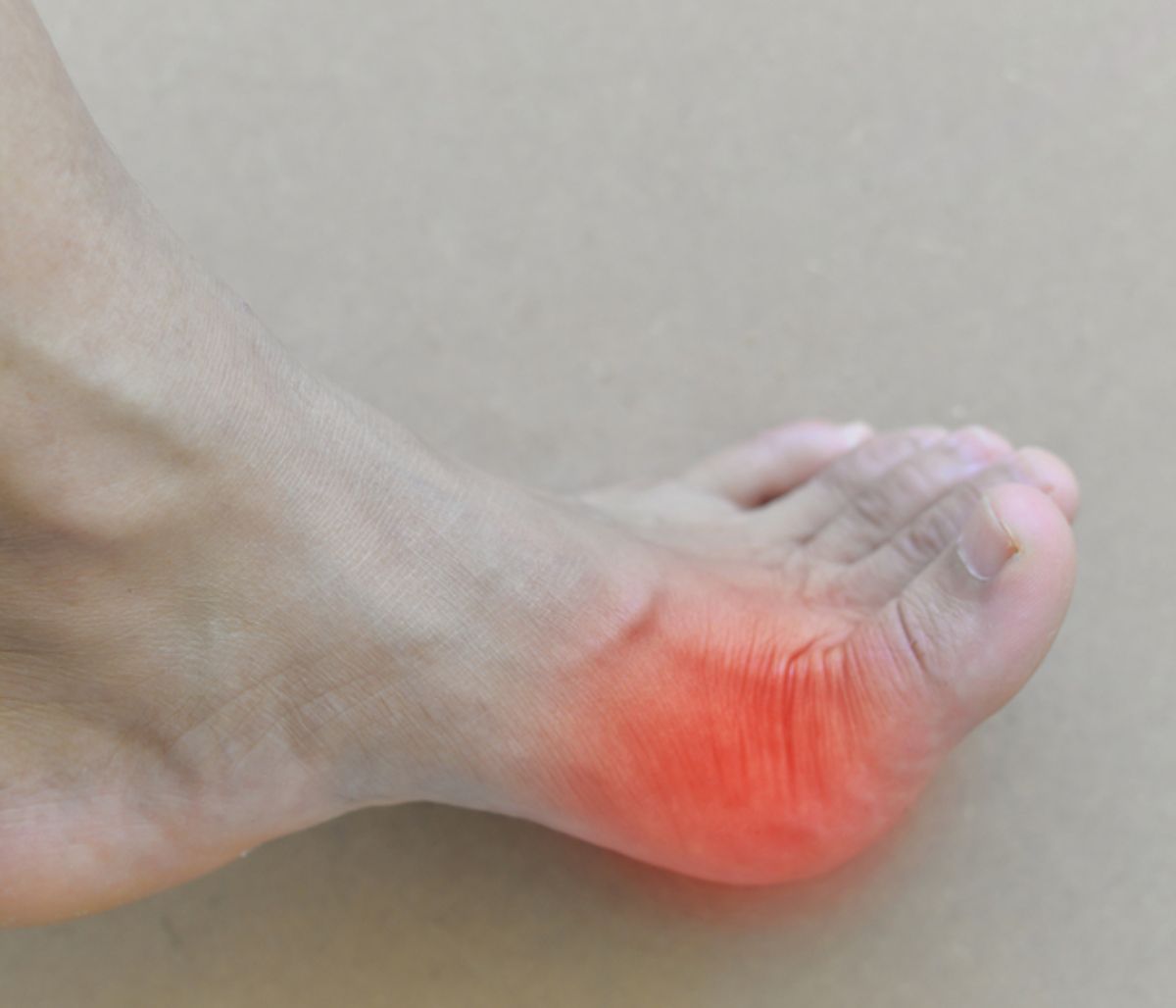 Υψηλό ουρικό οξύ: Πώς θα προλάβετε τα επεισόδια ουρικής αρθρίτιδας (εικόνες)