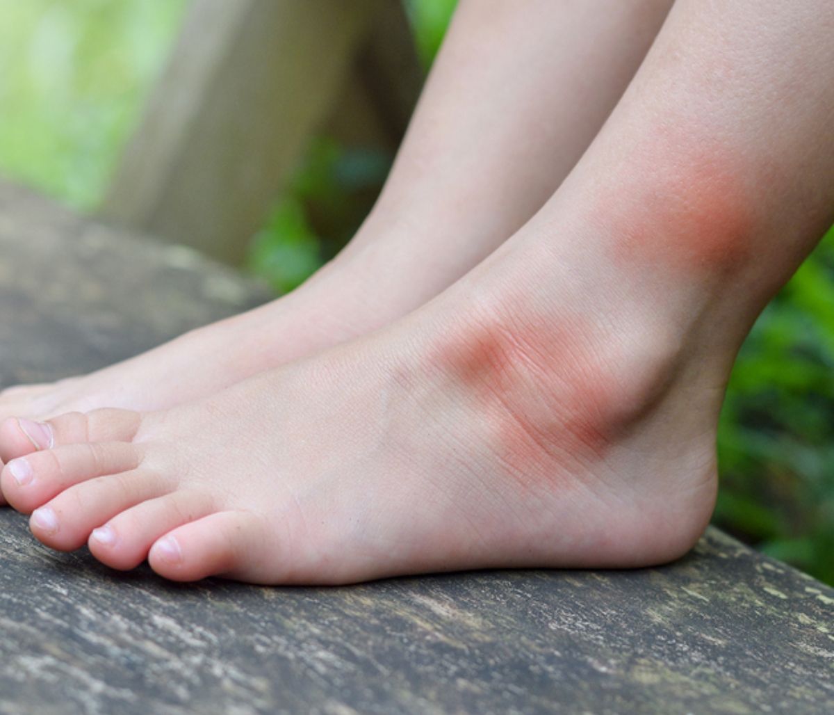 Αλλεργία στο τσίμπημα κουνουπιού: Τα ανησυχητικά συμπτώματα (εικόνες)