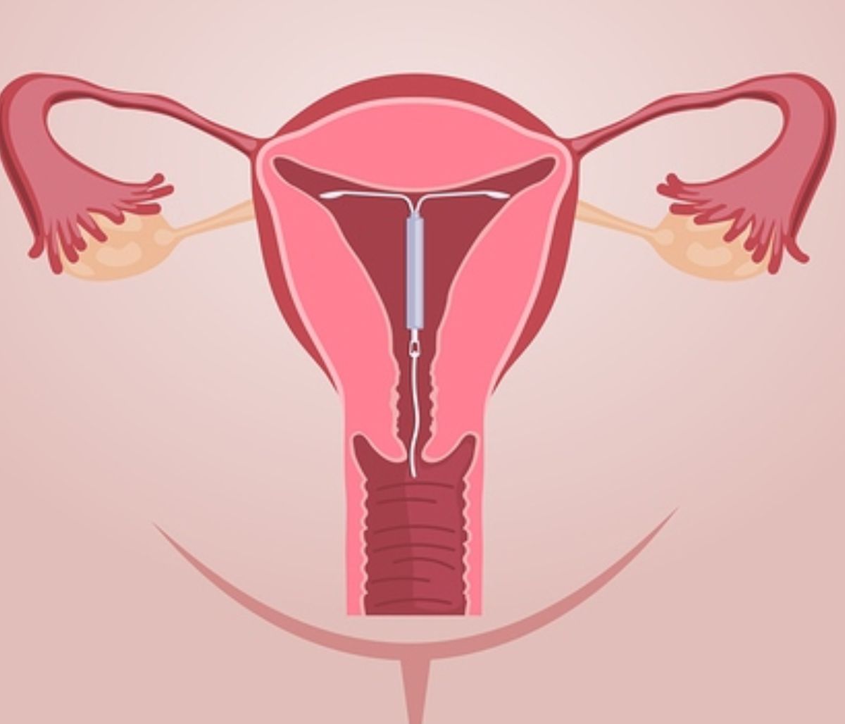 Ενδομήτριο σπείραμα & σεξ: Τι πρέπει να γνωρίζετε