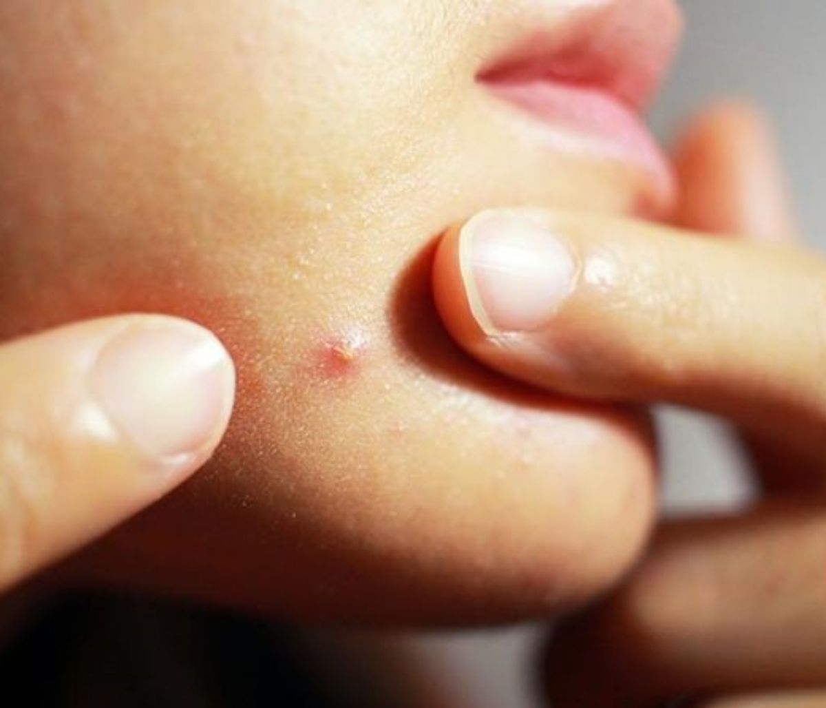 Ακμή στο πιγούνι: Αίτια και αντιμετώπιση