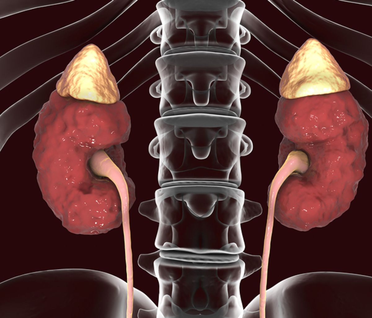 Οξεία πυελονεφρίτιδα: 7 συμπτώματα που δεν πρέπει να αγνοήσετε (εικόνες)