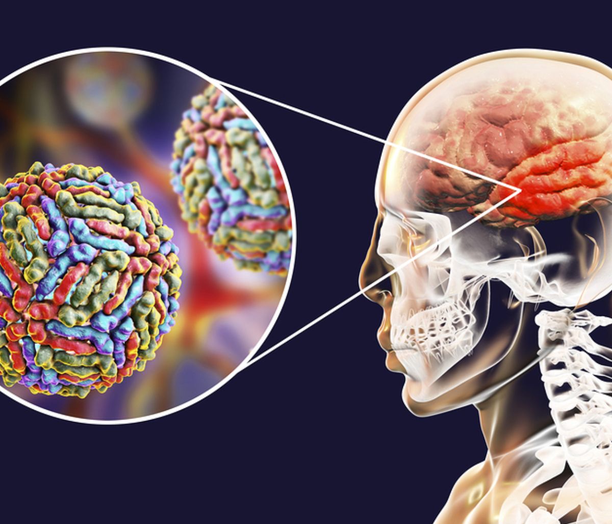 Εγκεφαλίτιδα: 6 ενδείξεις σε εικόνες