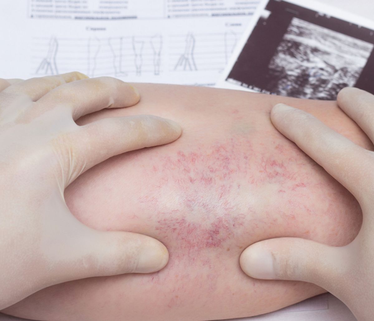 Θρομβοφλεβίτιδα: Οι βασικοί παράγοντες κινδύνου της απειλητικής κατάστασης (εικόνες)