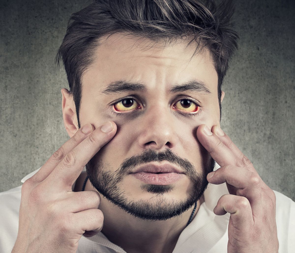 Κίτρινα μάτια: 10 πιθανές αιτίες σε εικόνες