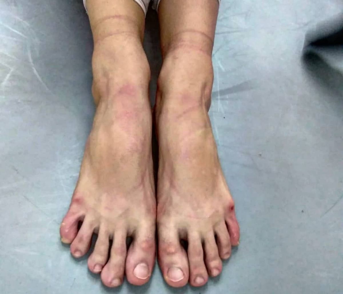 Γνωστή Ελληνίδα ηθοποιός γεμάτη πληγές στα πόδια της -Τι της συνέβη;  (pics)