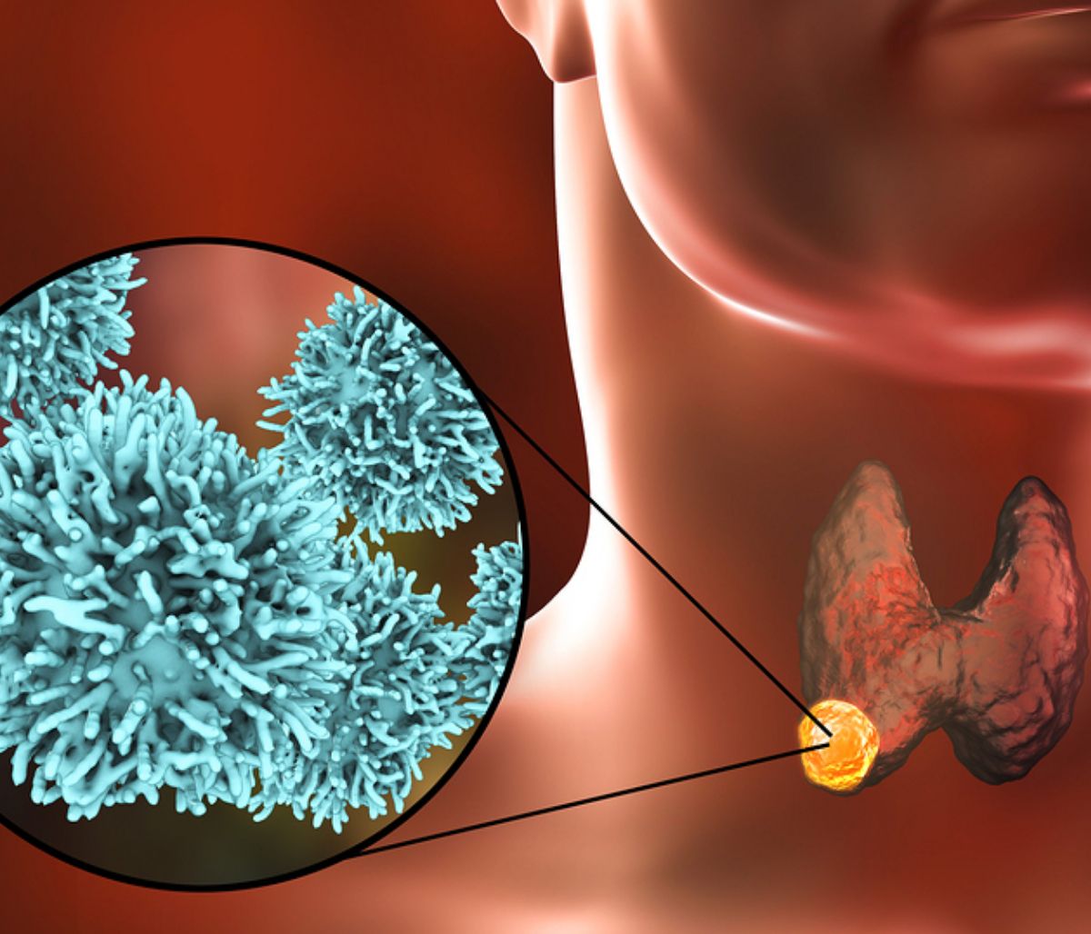 Καρκίνος θυρεοειδούς: Τα βασικά συμπτώματα σε εικόνες