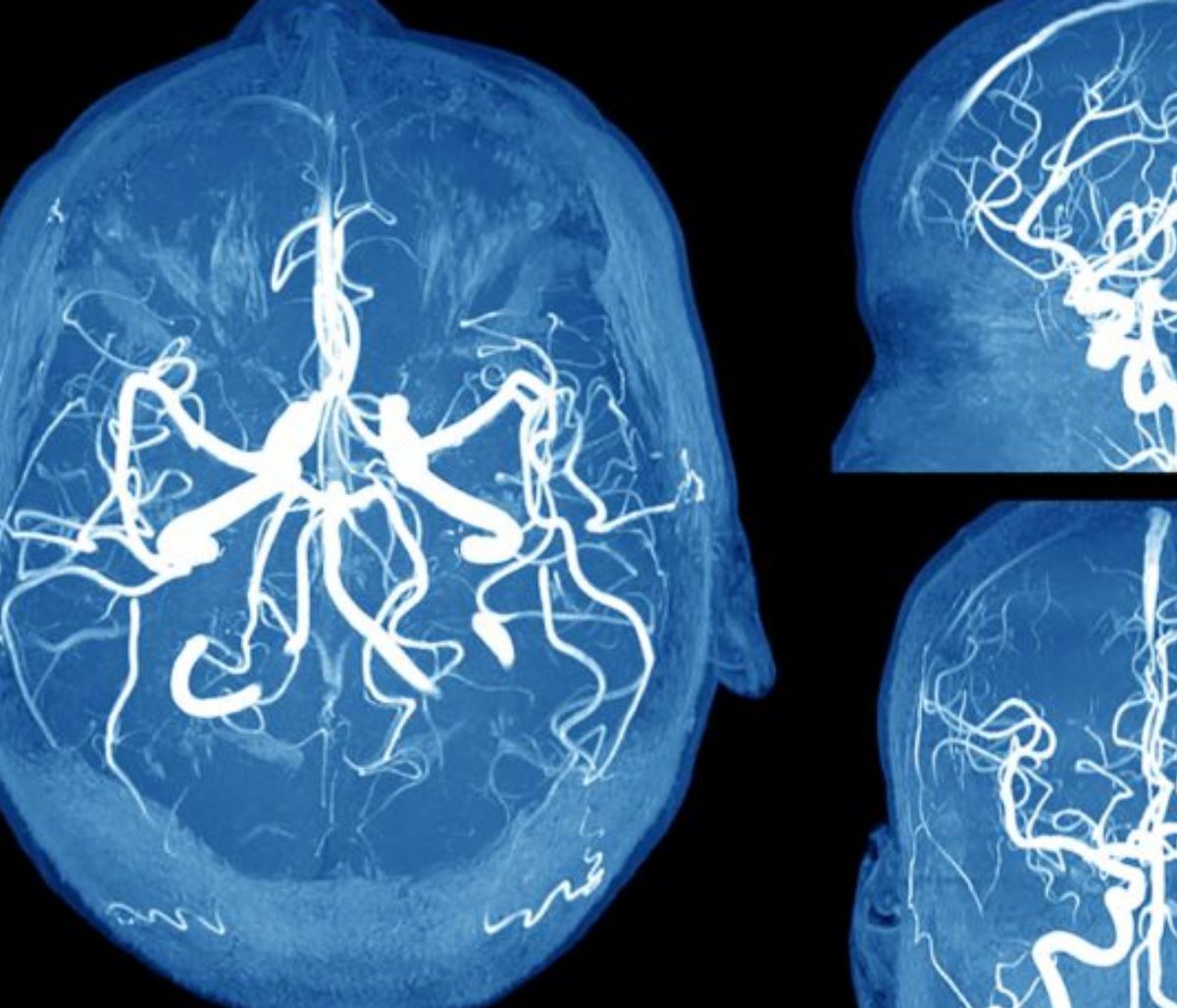 Ανεύρυσμα εγκεφάλου: Τα συμπτώματα SOS που πρέπει να γνωρίζετε (φωτο)