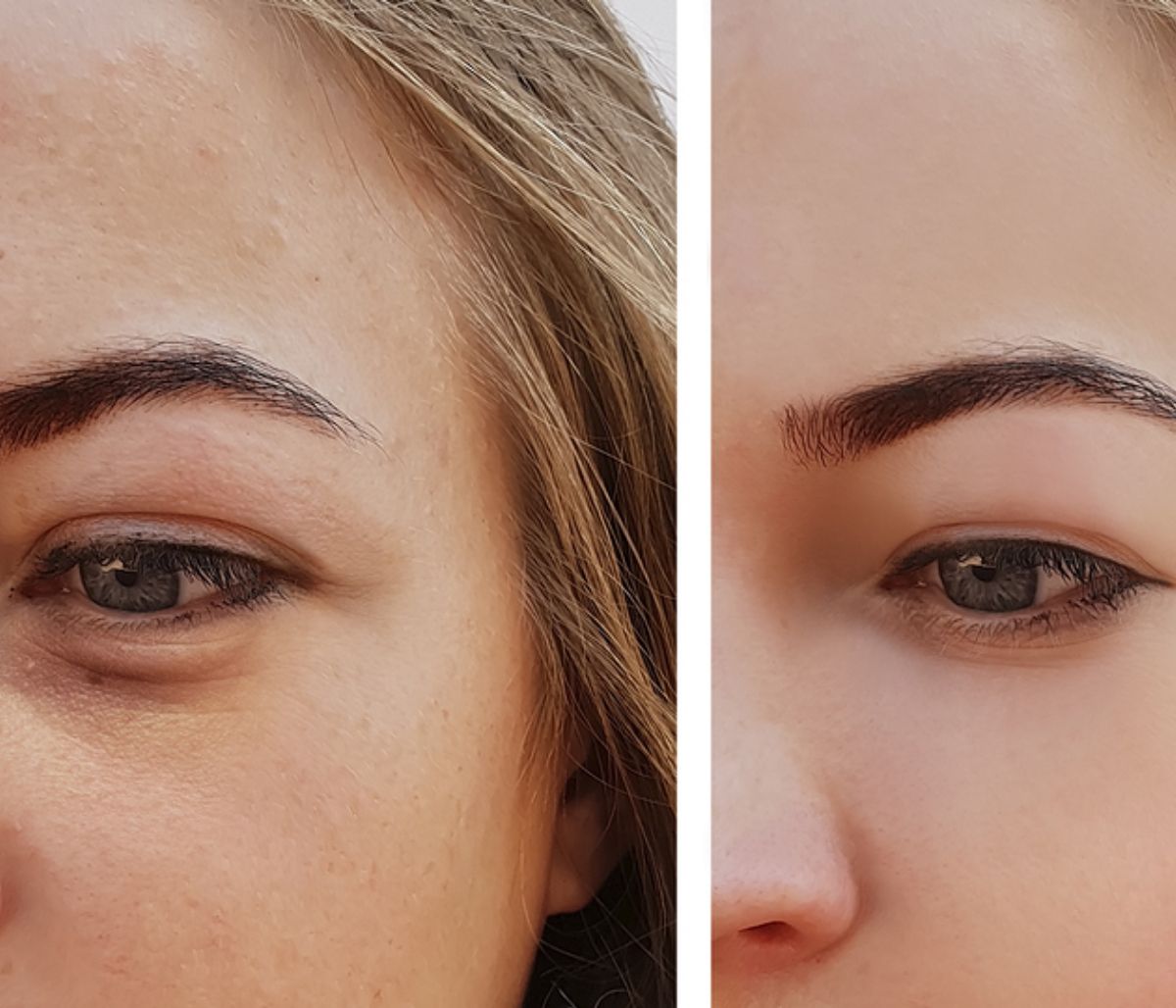 Σακούλες κάτω από τα μάτια: Πώς θα τις εξαφανίσετε (εικόνες)