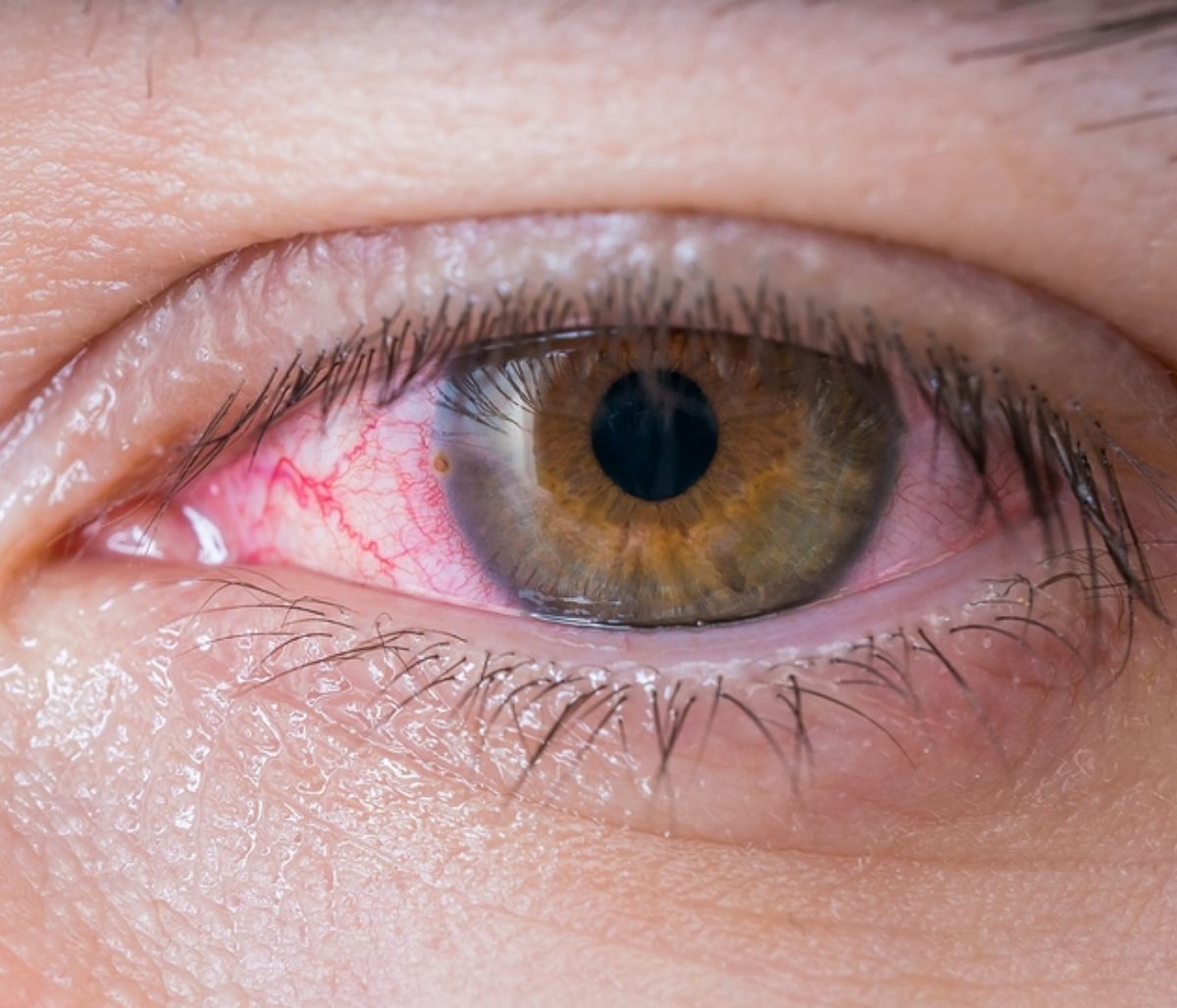 Κοκκίνισμα ματιών: 9 αιτίες & τι μπορείτε να κάνετε (φωτο)