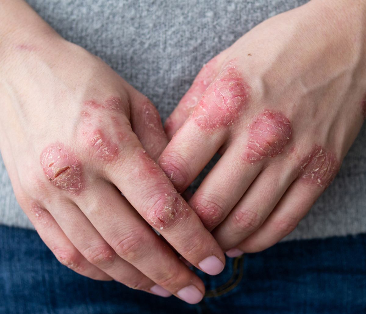 Ψωρίαση: Οι τροφές που αμβλύνουν τα συμπτώματα (εικόνες)