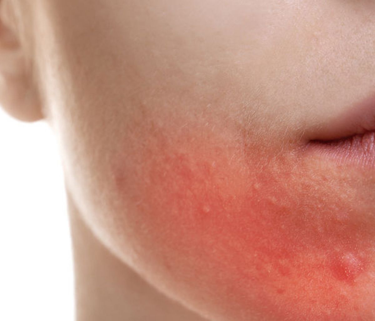 Οι «καλές» συνήθειες που πυροδοτούν την ακμή (εικόνες)