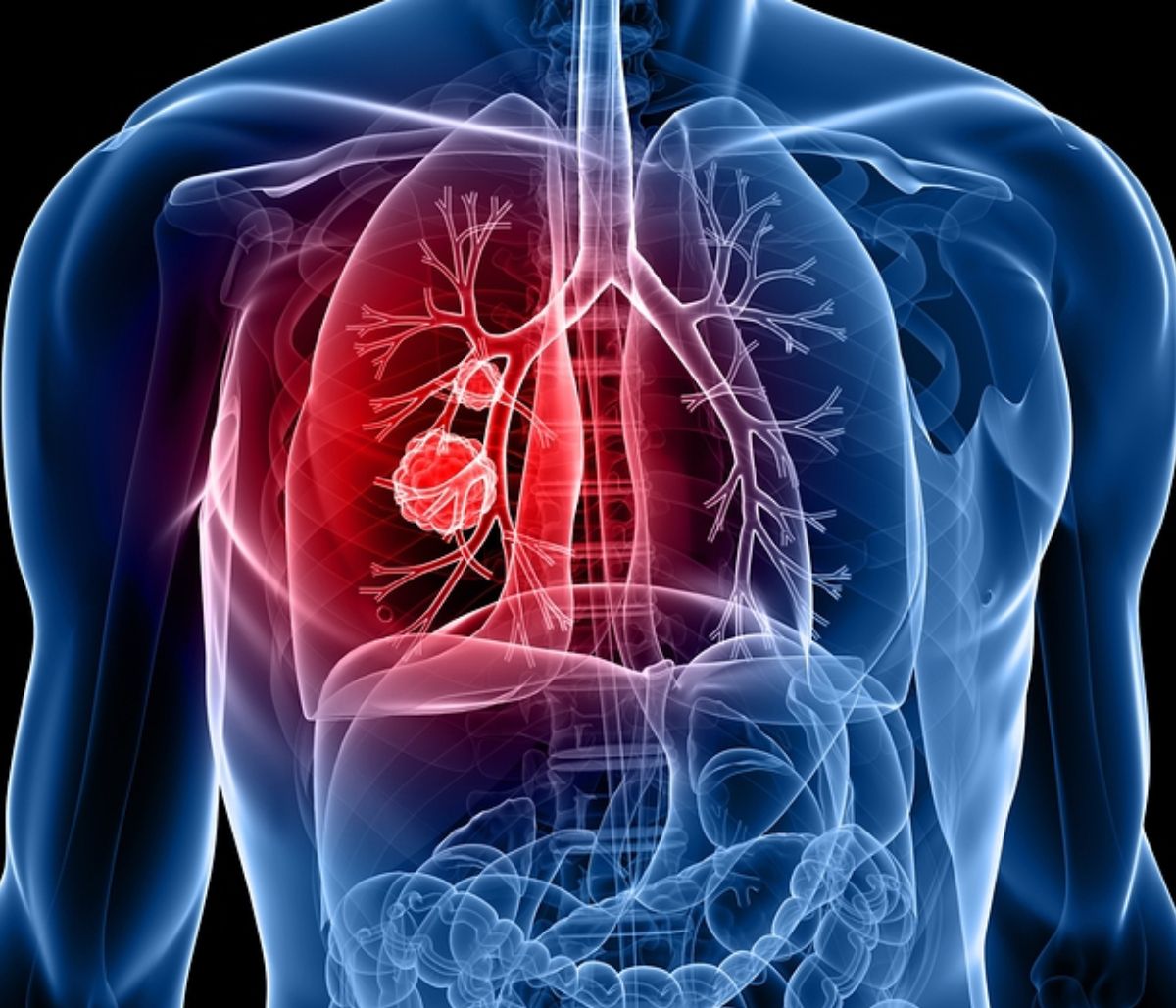 Καρκίνος πνεύμονα: 7 σημάδια που πιθανώς αγνοείτε (εικόνες)