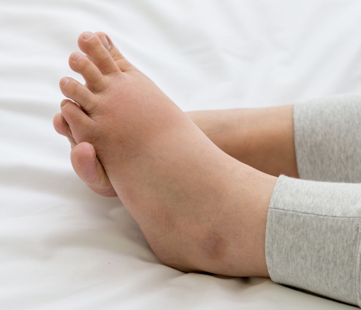 Πρησμένα πόδια λόγω κατακράτησης υγρών: Πώς θα το αντιμετωπίσετε (εικόνες)