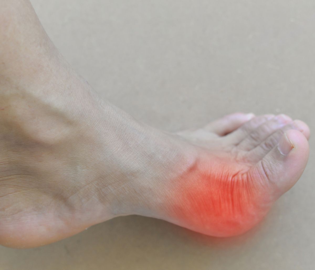 Υψηλό ουρικό οξύ: Πώς θα προλάβετε τα επεισόδια ουρικής αρθρίτιδας φυσικά (εικόνες)