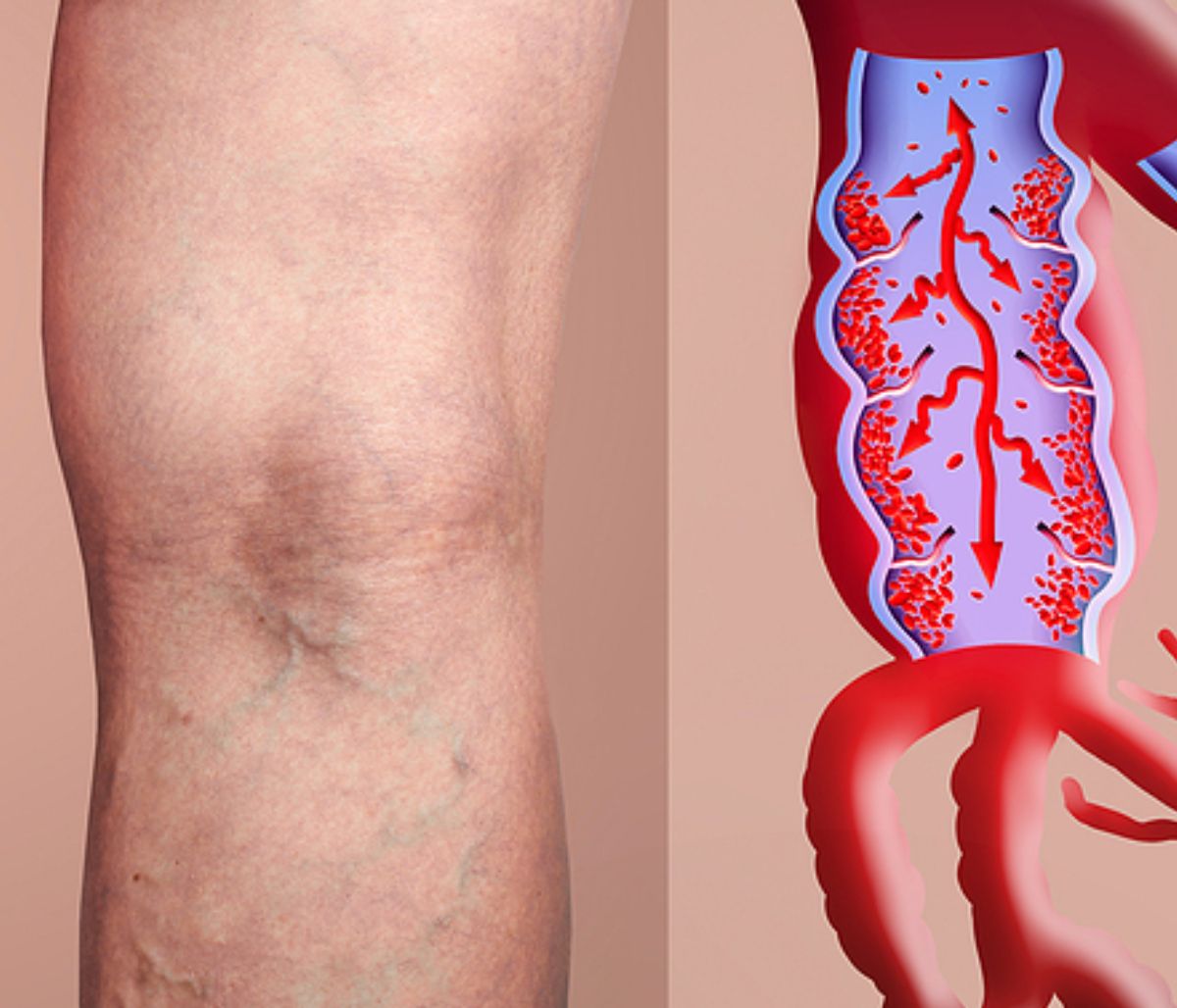 Θρόμβωση: Τα σημάδια-SOS που πρέπει να γνωρίζετε (εικόνες)