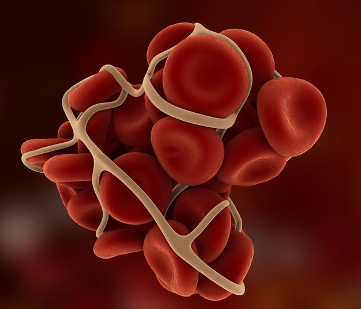 Θρόμβος στο πόδι: 5 τροφές που τον προλαμβάνουν (εικόνες)