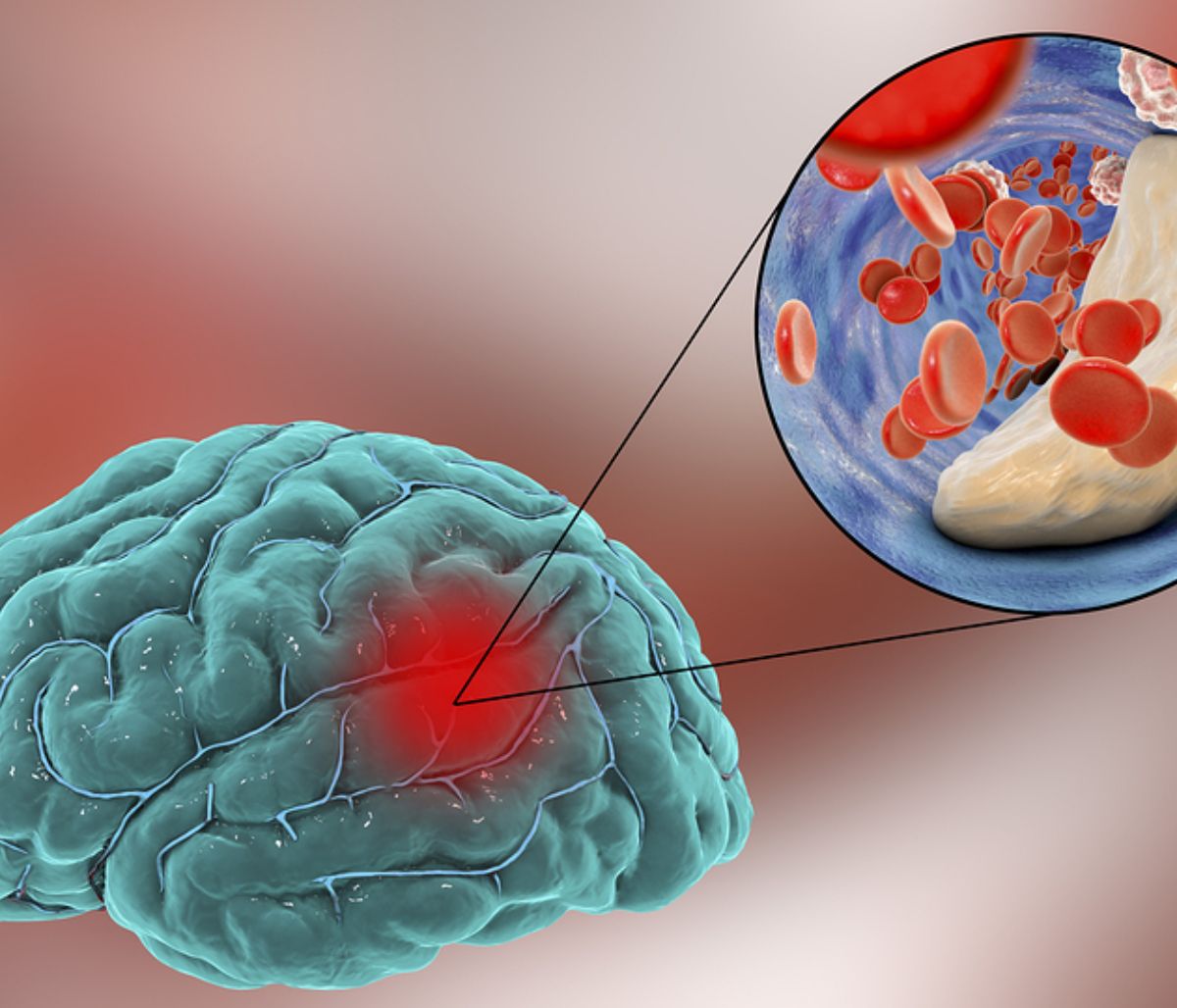 Εγκεφαλικό: Οι τροφές που μειώνουν τον κίνδυνο (εικόνες)