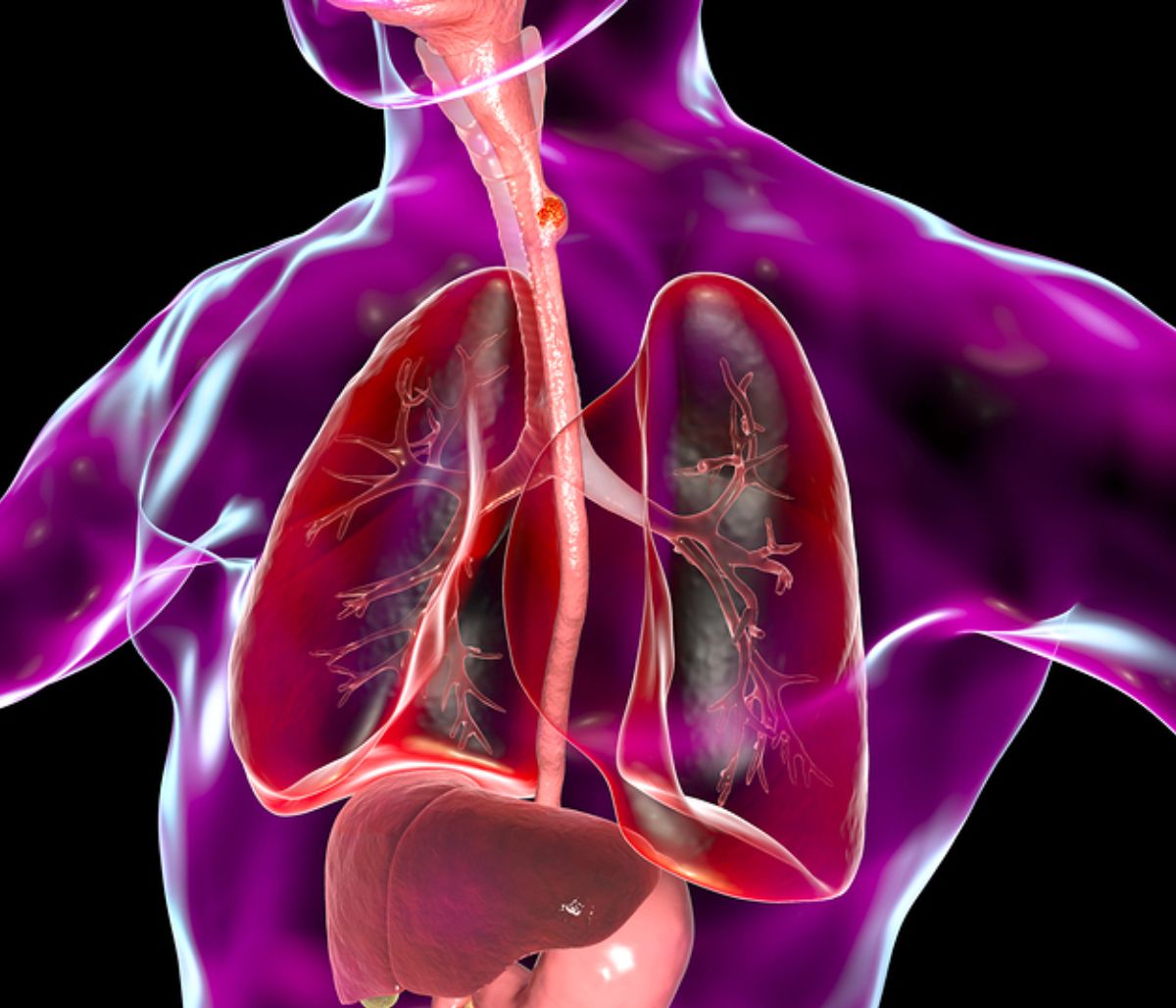 Καρκίνος οισοφάγου: 4 ύποπτα συμπτώματα (εικόνες)