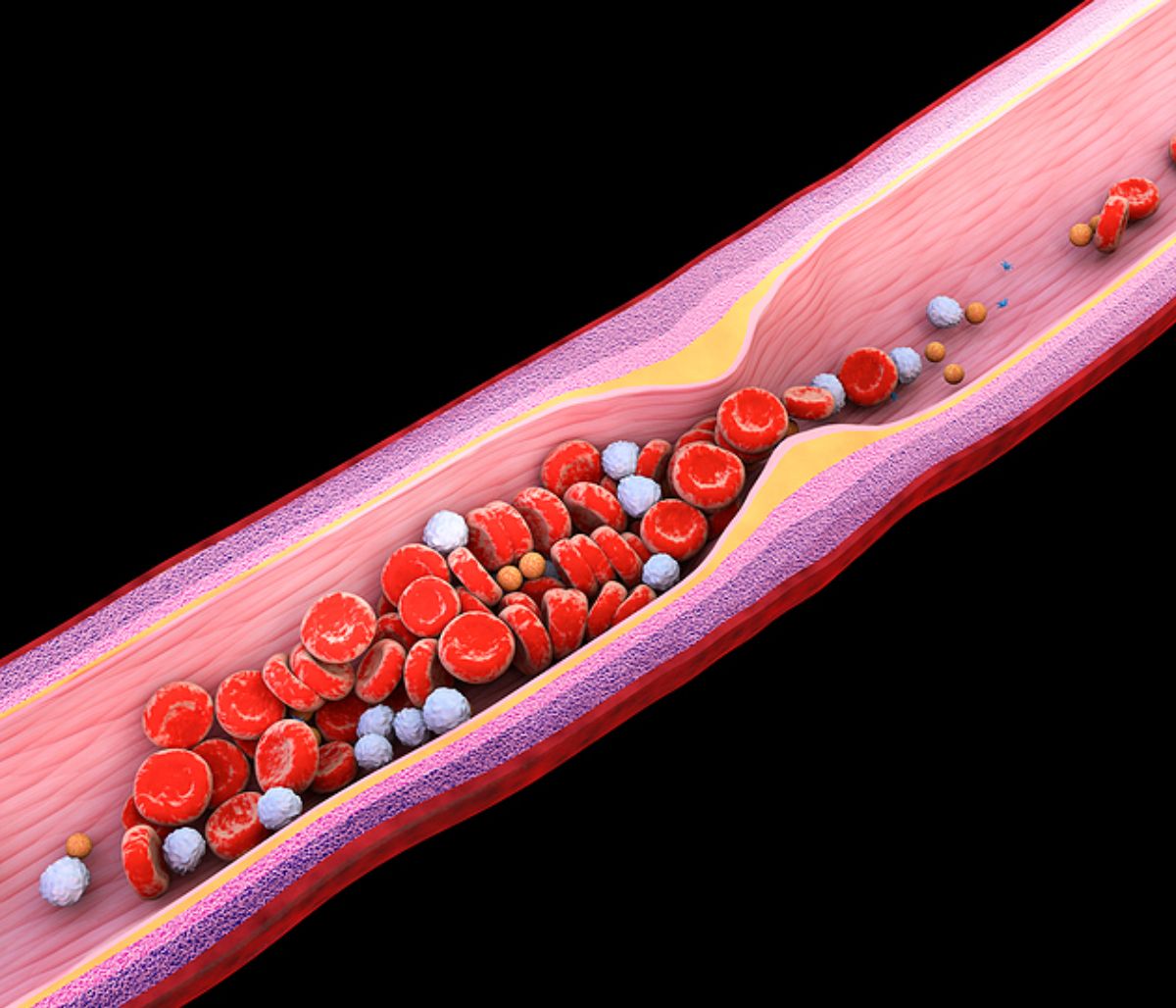 Υψηλή χοληστερίνη: Οι άγνωστες επιπτώσεις πλην του εμφράγματος και του εγκεφαλικού (εικόνες)