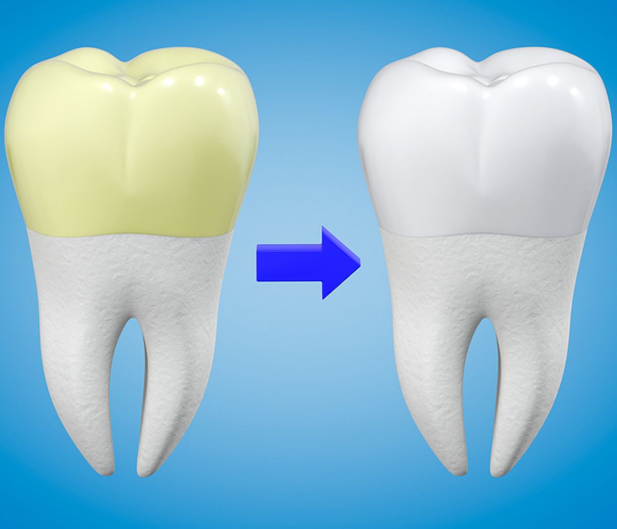 Πλάκα στα δόντια: 14 τρόποι να την απομακρύνετε φυσικά (video)