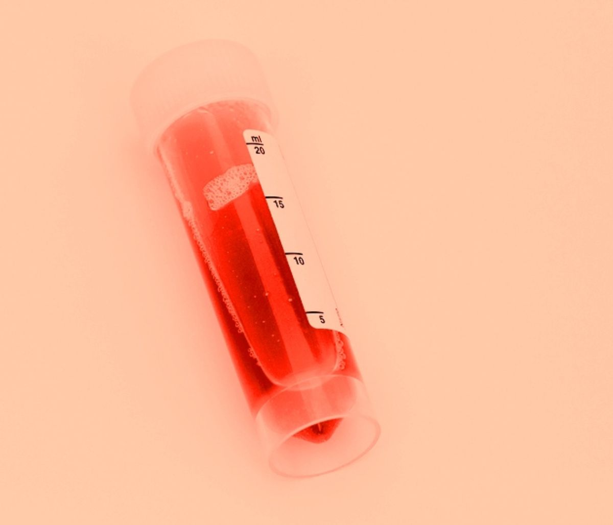 Αίμα στα ούρα: Όλες οι πιθανές αιτίες σε εικόνες