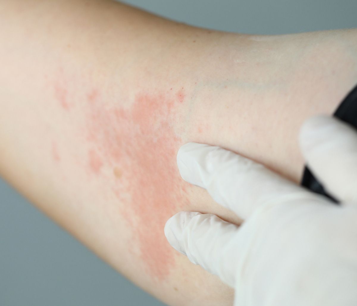 9 σημάδια στην επιδερμίδα που μαρτυρούν πρόβλημα υγείας (video)