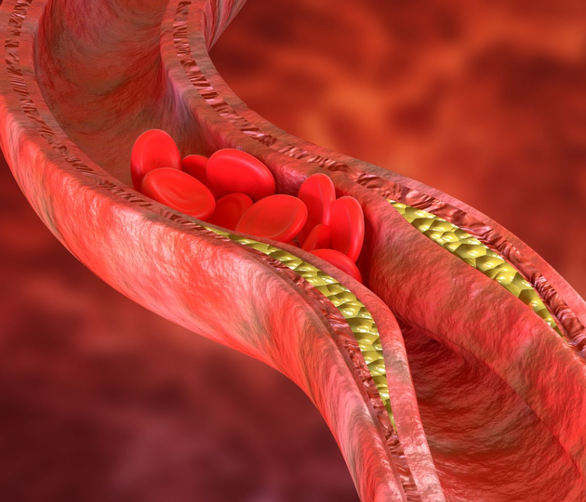 Βουλωμένες αρτηρίες: Προσοχή σε αυτά τα «αθόρυβα» συμπτώματα! (εικόνες)