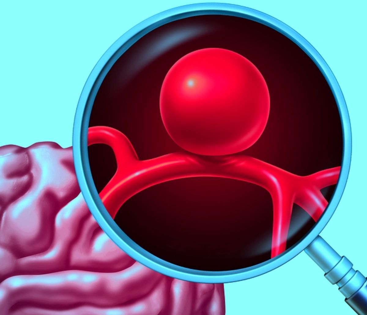 Ανεύρυσμα: Οι κύριες αιτίες ρήξης (εικόνες)