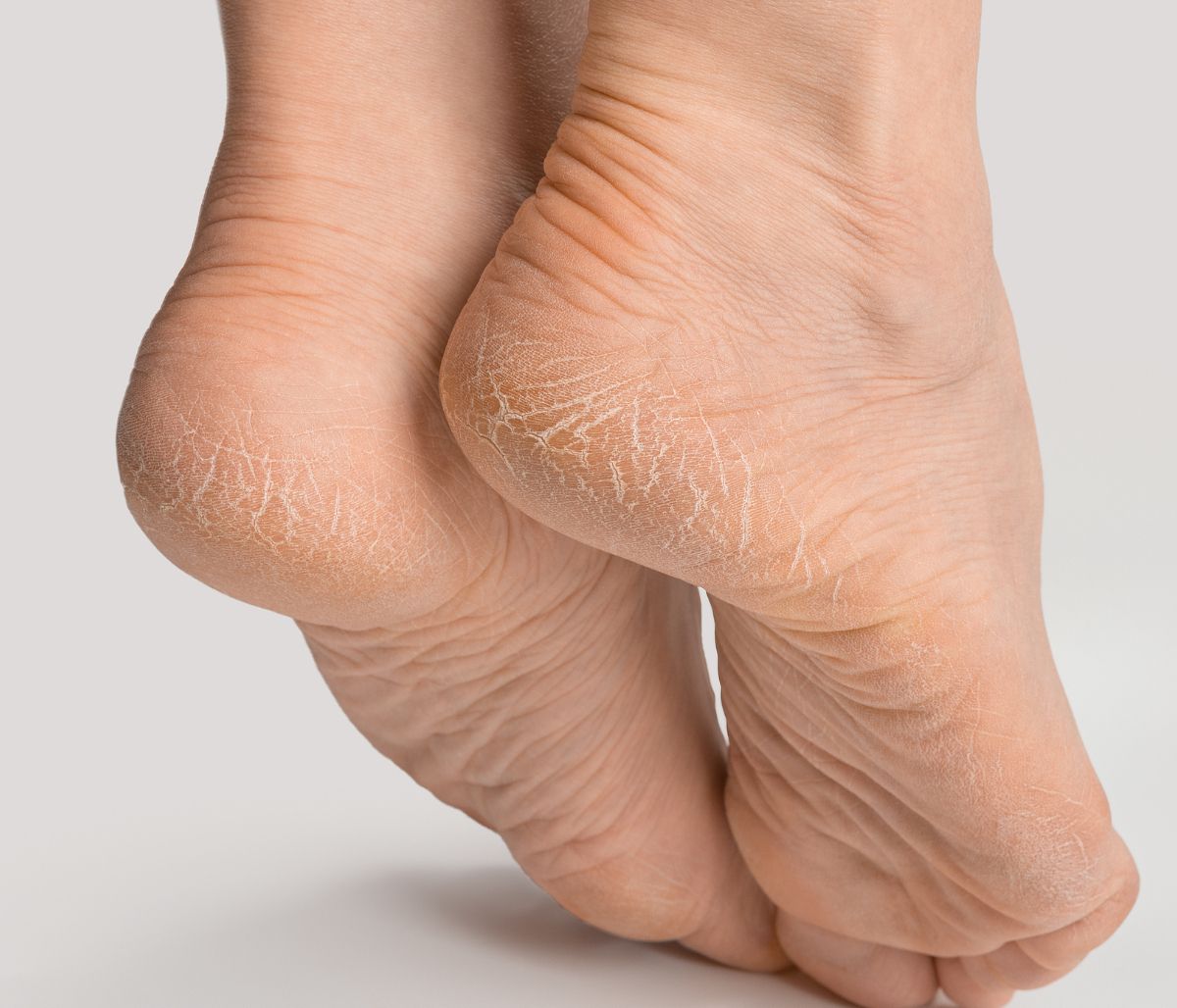 Σκληρύνσεις και κάλοι: Πώς θα απαλλαγείτε (video)