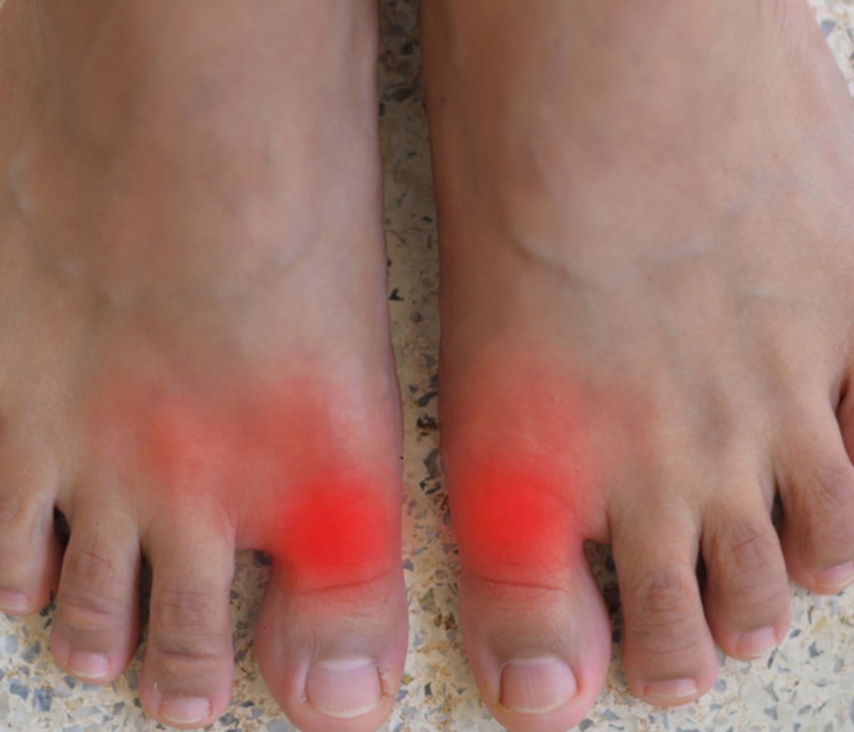 Ουρική αρθρίτιδα: Ποιοι κινδυνεύουν από τη φλεγμονώδη νόσο των αρθρώσεων (εικόνες)