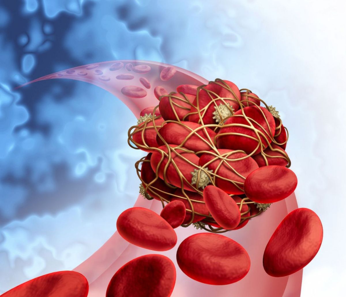 Θρόμβωση: Τα σημάδια που δεν πρέπει να αγνοείτε (video)