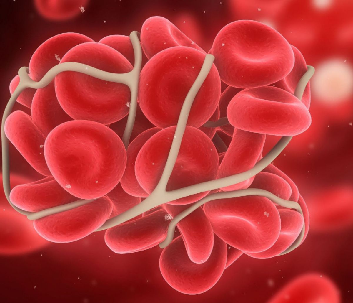 Θρόμβος: Ποια συμπτώματα προκαλεί ανάλογα με το σημείο που εντοπίζεται (εικόνες)