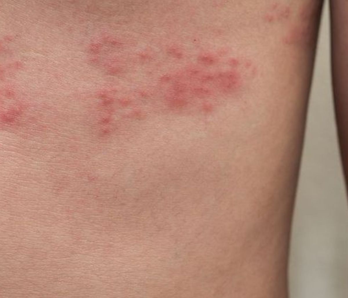 Έρπητας ζωστήρας: Γνωστό αντικαταθλιπτικό για τη θεραπεία της πάθησης δοκιμάζουν οι ερευνητές