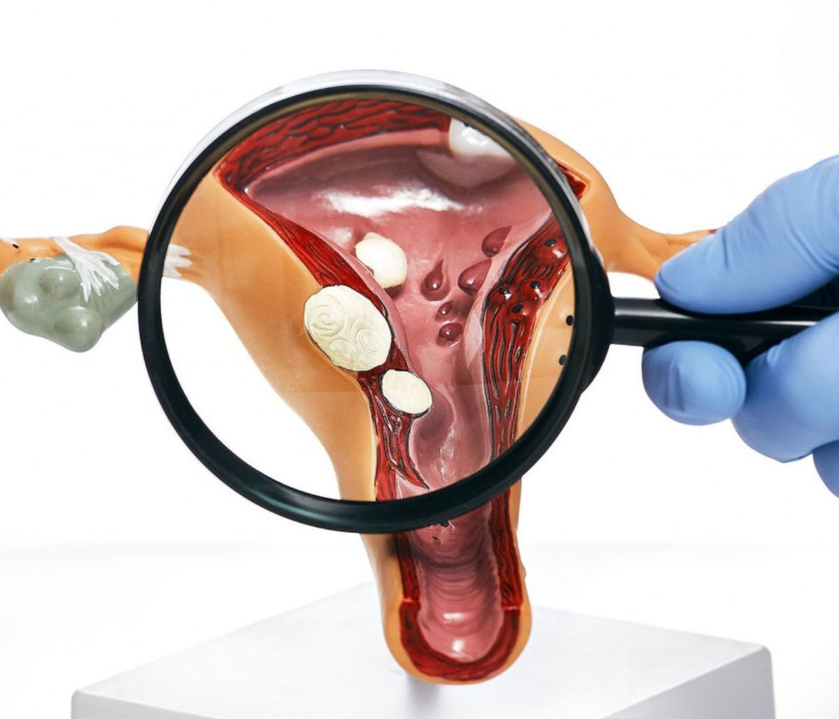 Πολύποδες στον τράχηλο: Οι ανησυχητικές ενδείξεις (εικόνες)