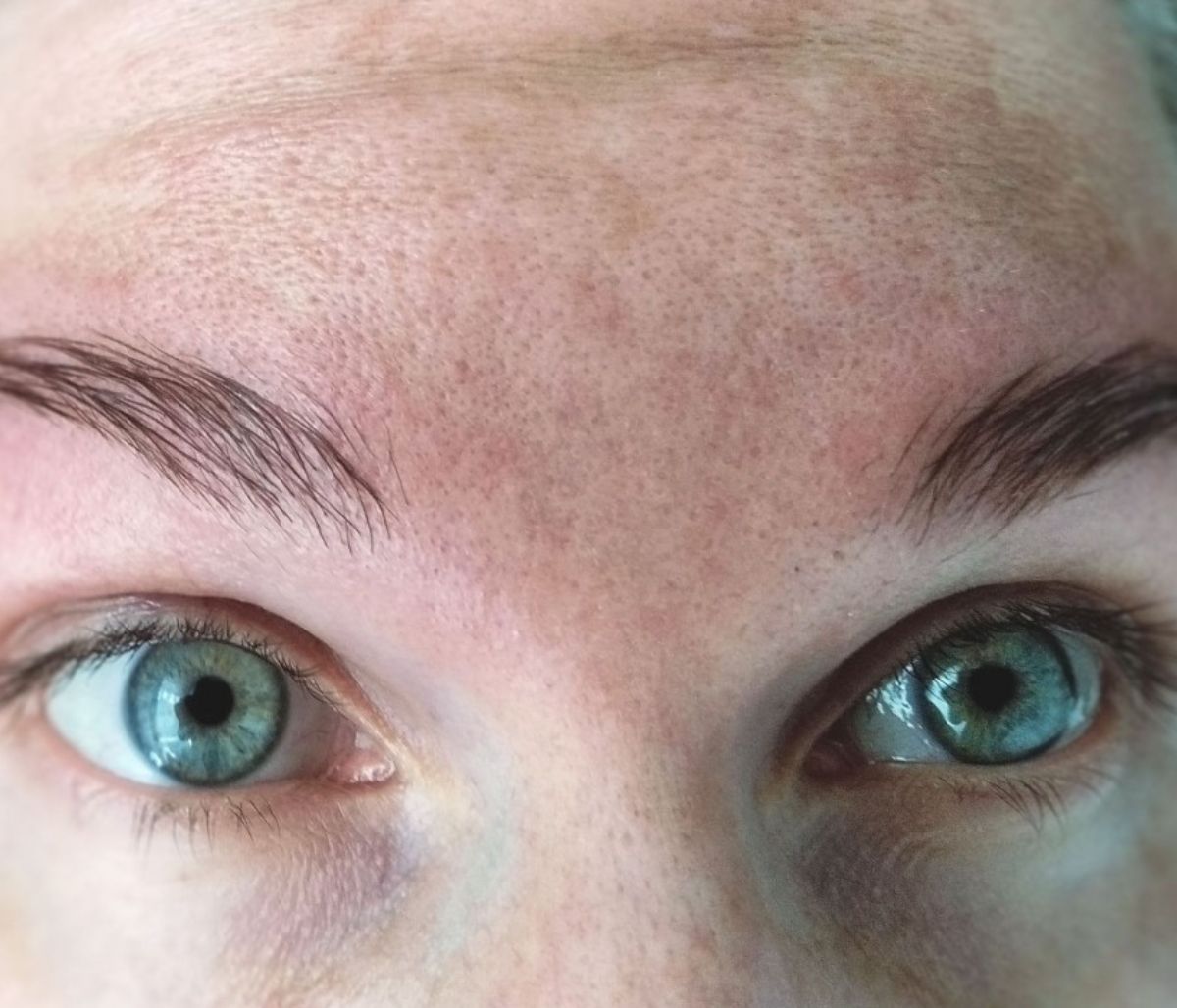 Μέλασμα ή πανάδες: Αντιμετώπιση με σπιτική μάσκα καρότου (video)