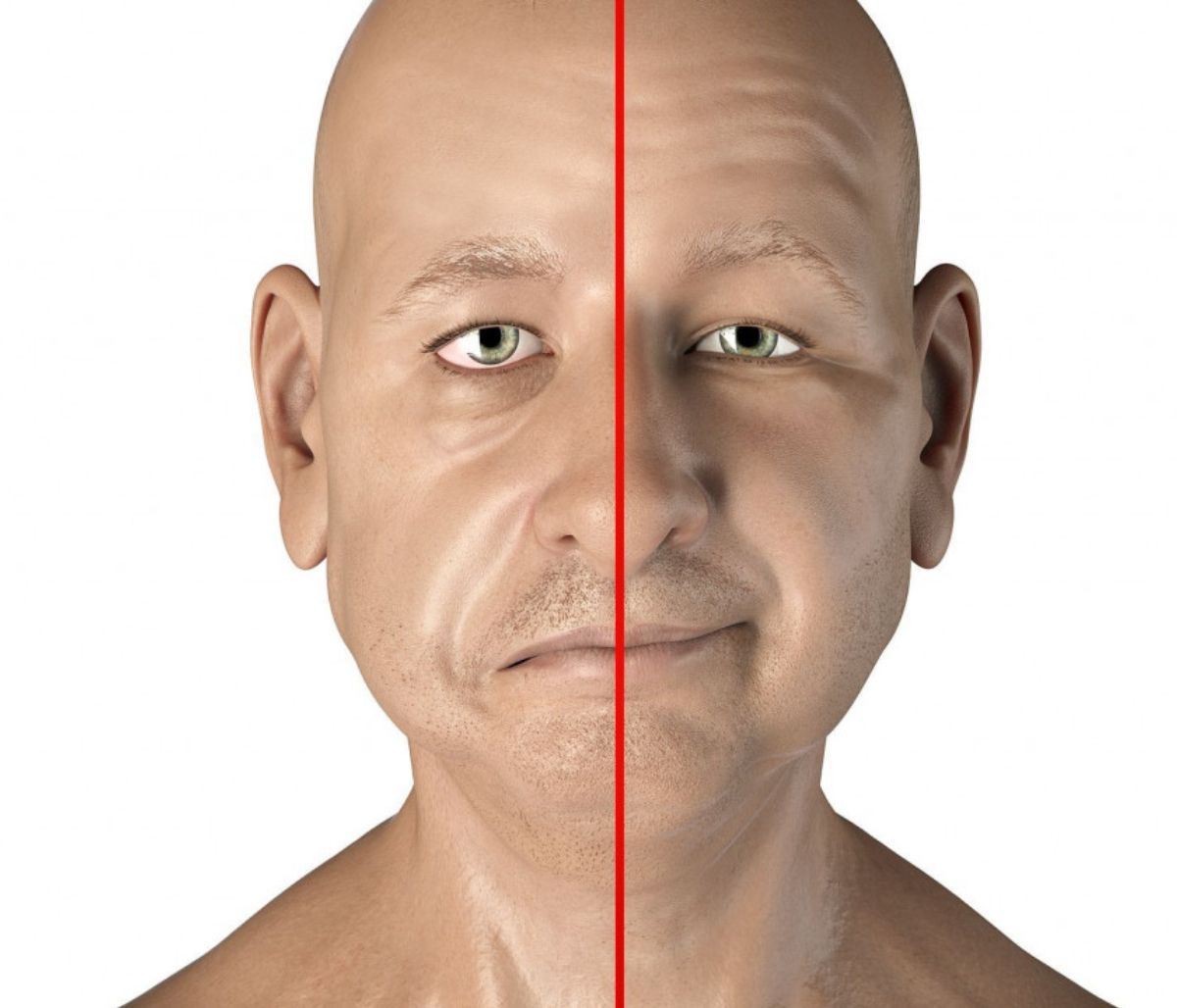 Παράλυση Bell: Οι αιτίες της εμφάνισης, τα συμπτώματα και η θεραπεία