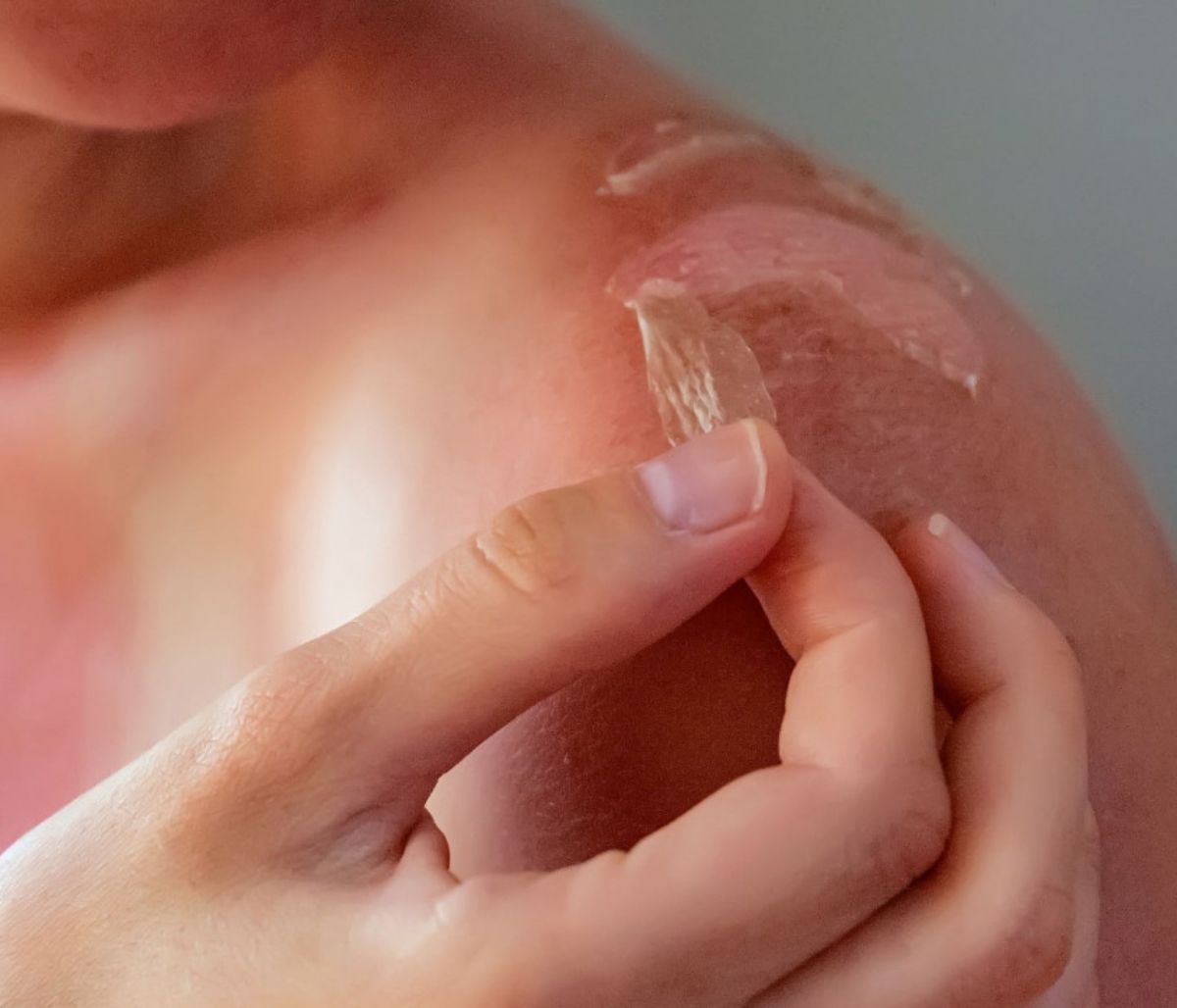 Πώς επιλέγουμε μια λοσιόν για να μας ανακουφίσει από το ηλιακό έγκαυμα