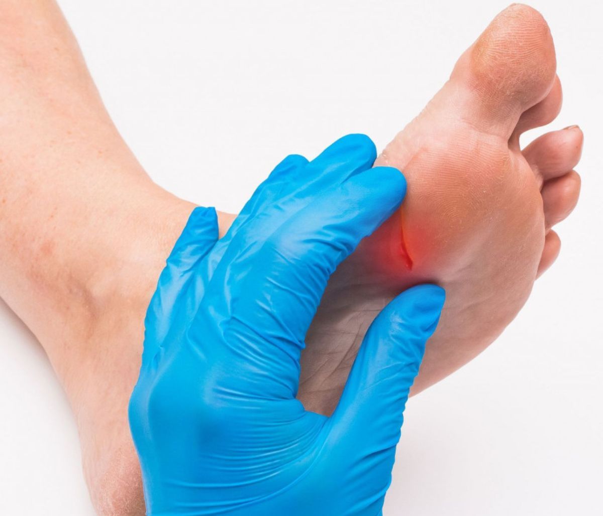 Διαβητικά έλκη: Πώς θα τα προλάβετε