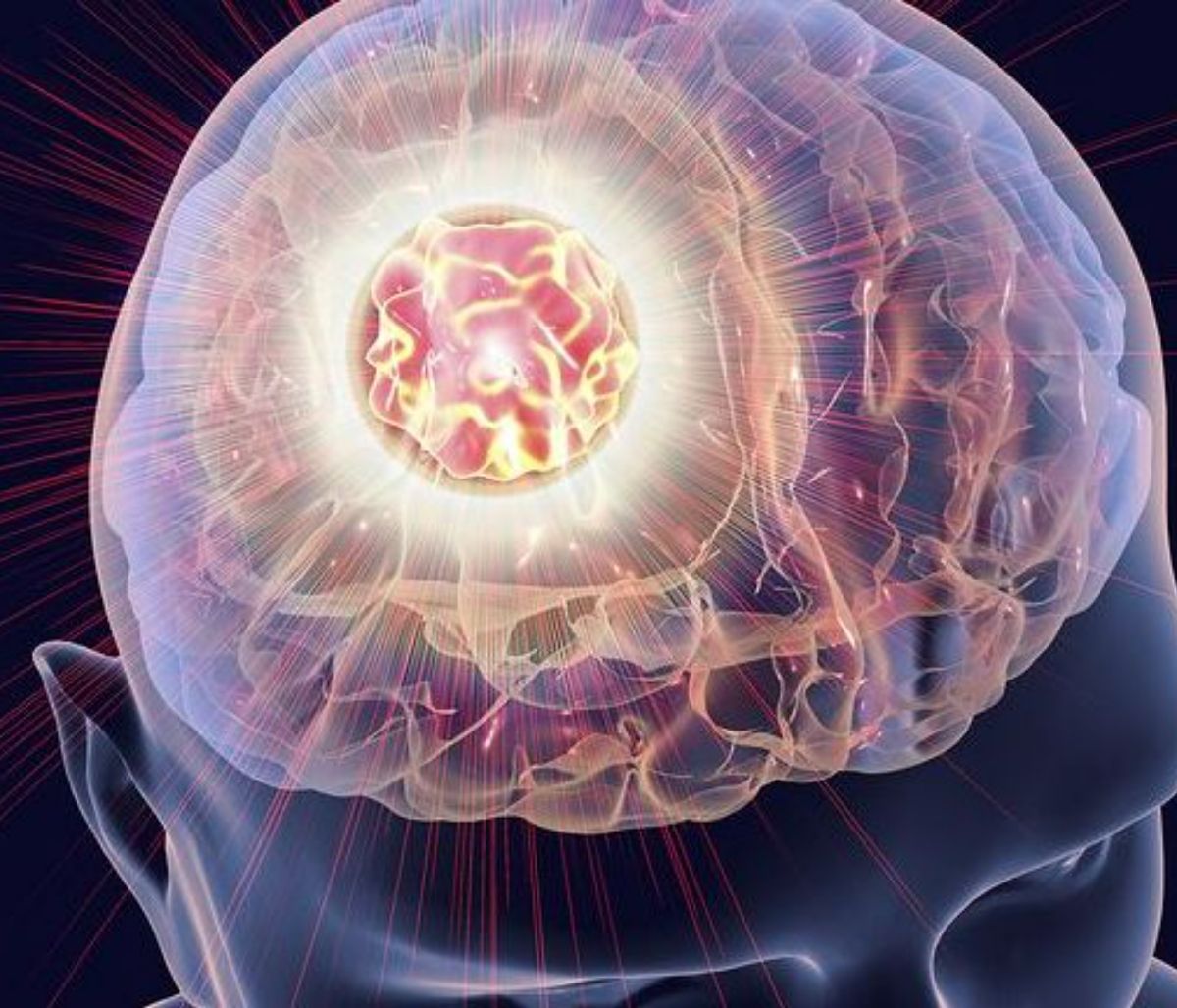 Όγκοι εγκεφάλου: Τα 7 πρώιμα σημάδια που πρέπει να προσέξετε