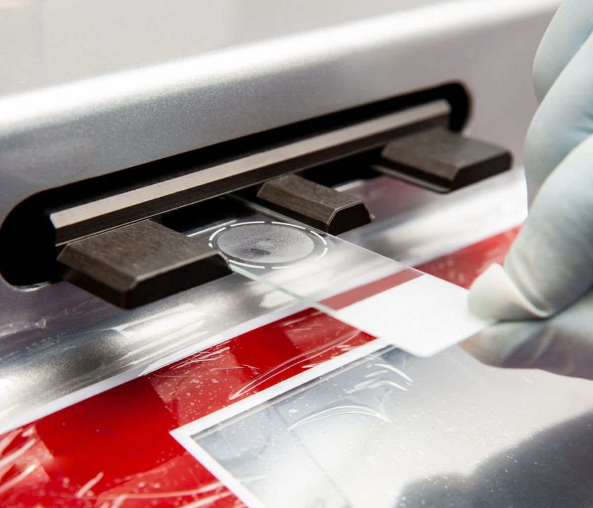 Καρκίνος τραχήλου: Το τεστ που τον εντοπίζει χρόνια πριν εμφανιστεί