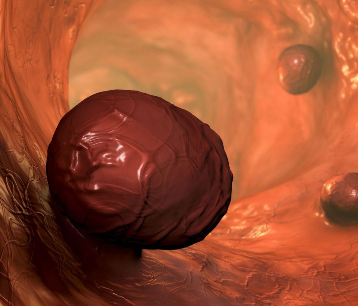 Πολύποδες παχέος εντέρου: Με ποια συμπτώματα εκδηλώνονται