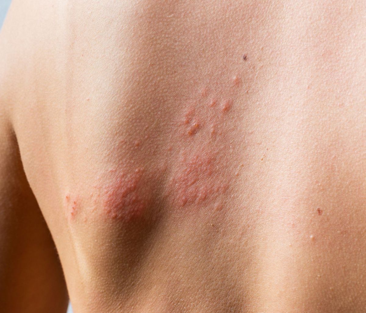 Ιός έρπητα ζωστήρα: Πώς συνδέεται με τον κίνδυνο εγκεφαλικού