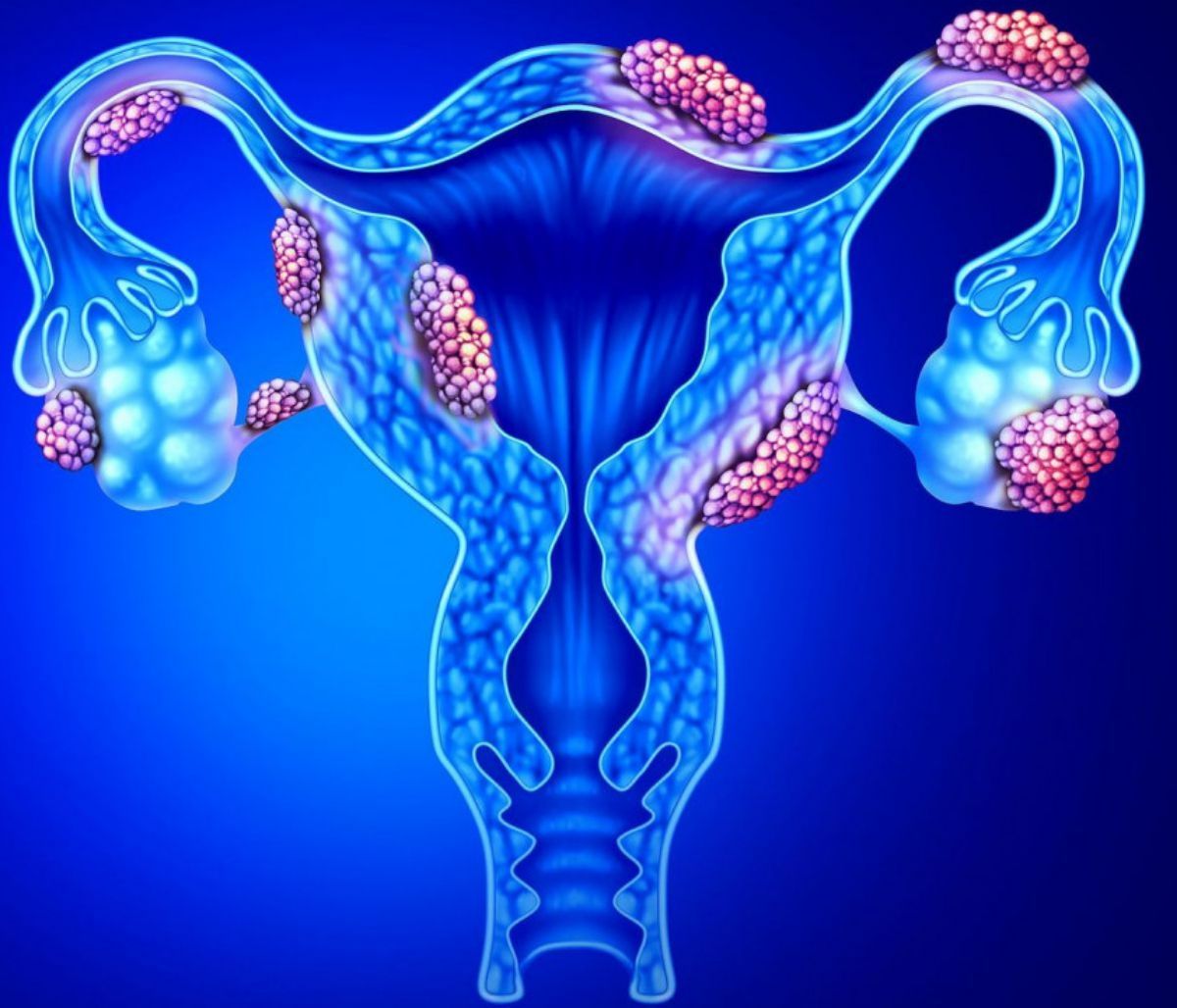 Ενδομητρίωση: Τα συμπτώματα μιας από τις κύριες αιτίες υπογονιμότητας