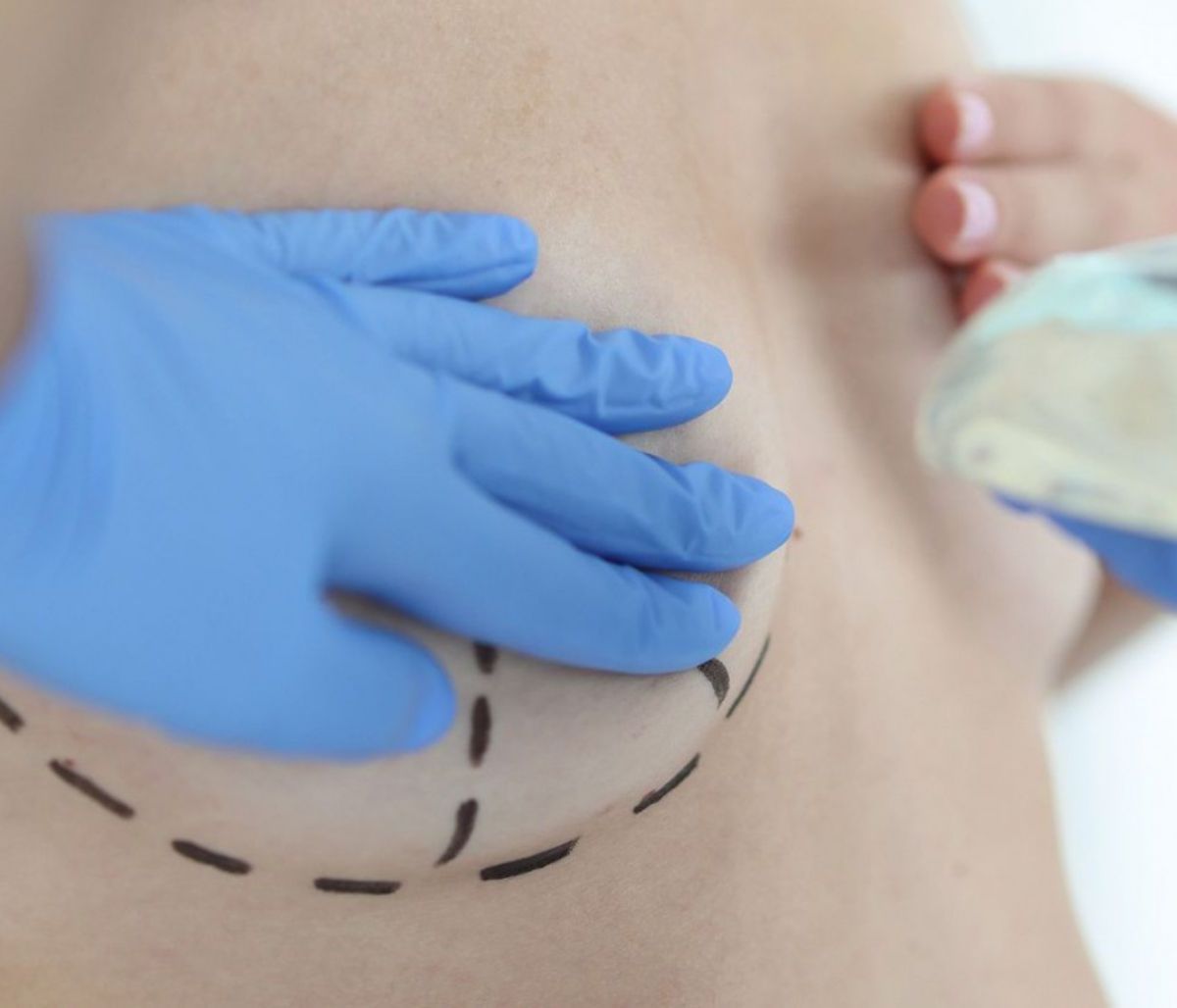 Aναπλαστικό μεγαλοκυτταρικό λέμφωμα: Ο ρόλος των εμφυτευμάτων στήθους