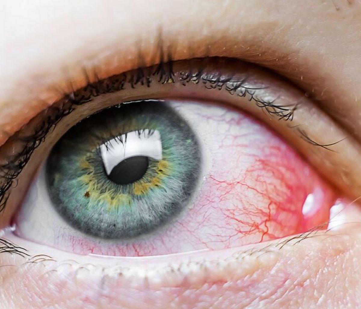 Επιπεφυκίτιδα: Τα είδη της και πώς θα την αντιμετωπίσετε