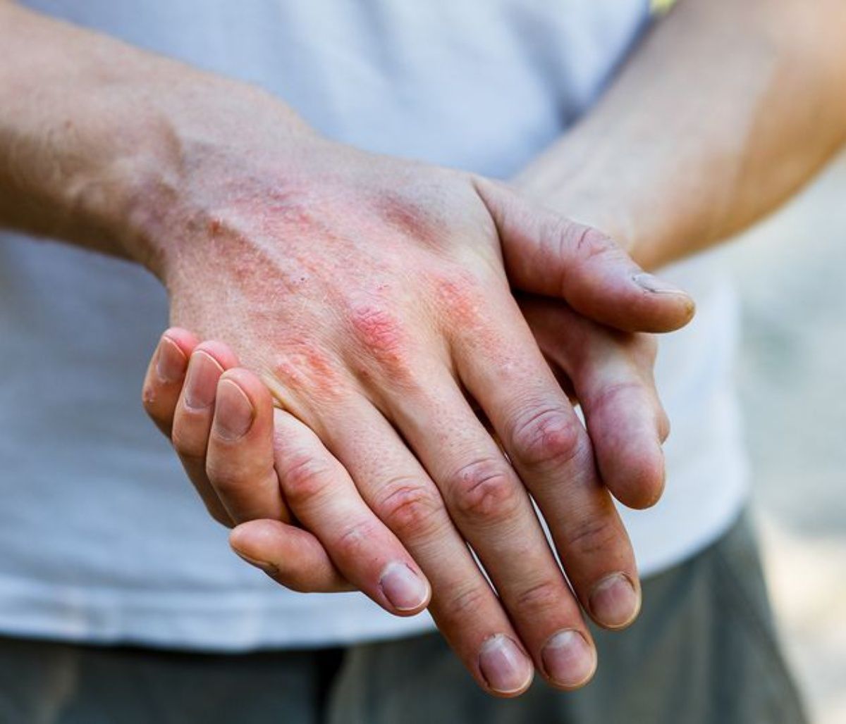 Ατοπική δερματίτιδα: Ποια η σχέση της με τις ημικρανίες